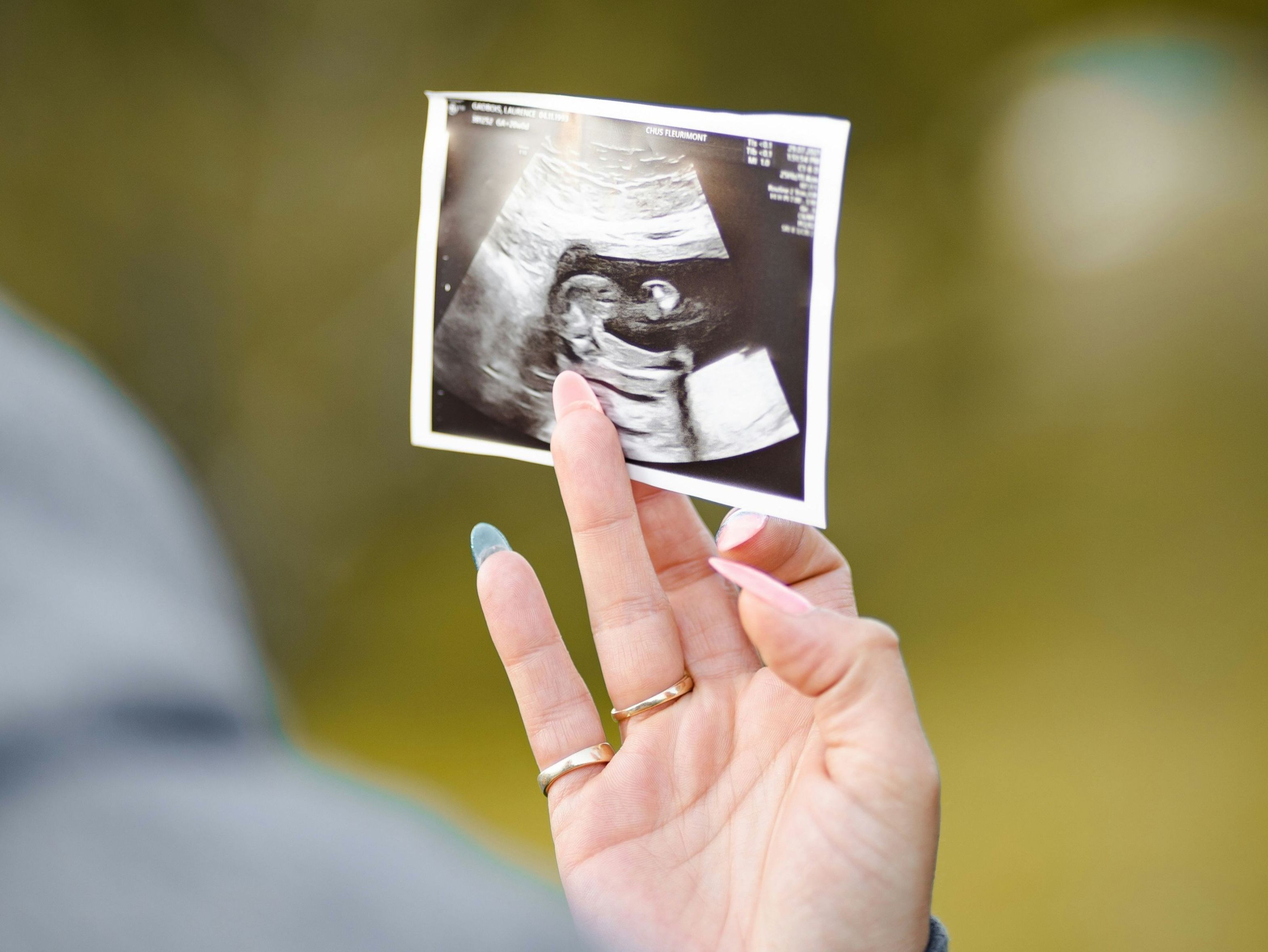 Frauenhand hält Ultraschallbild